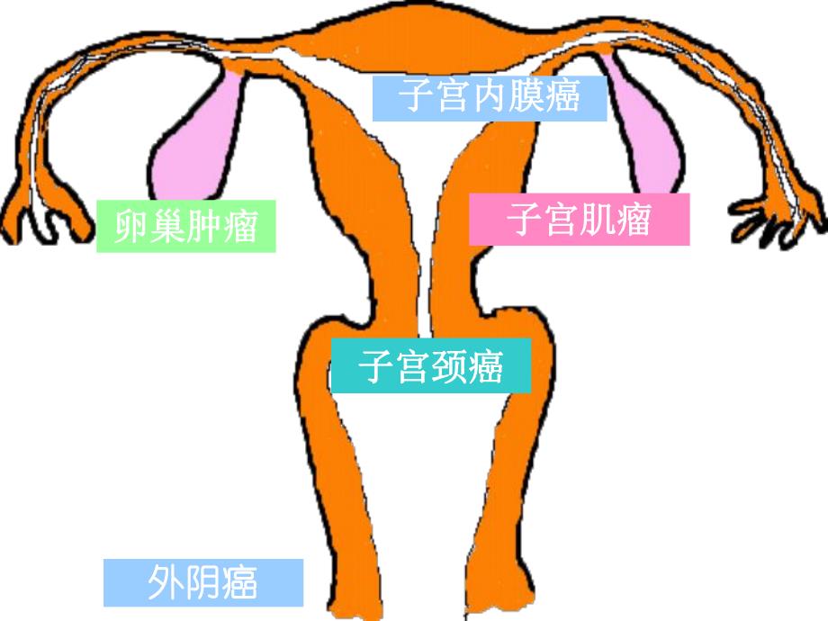 子宫颈癌PPT.ppt_第1页