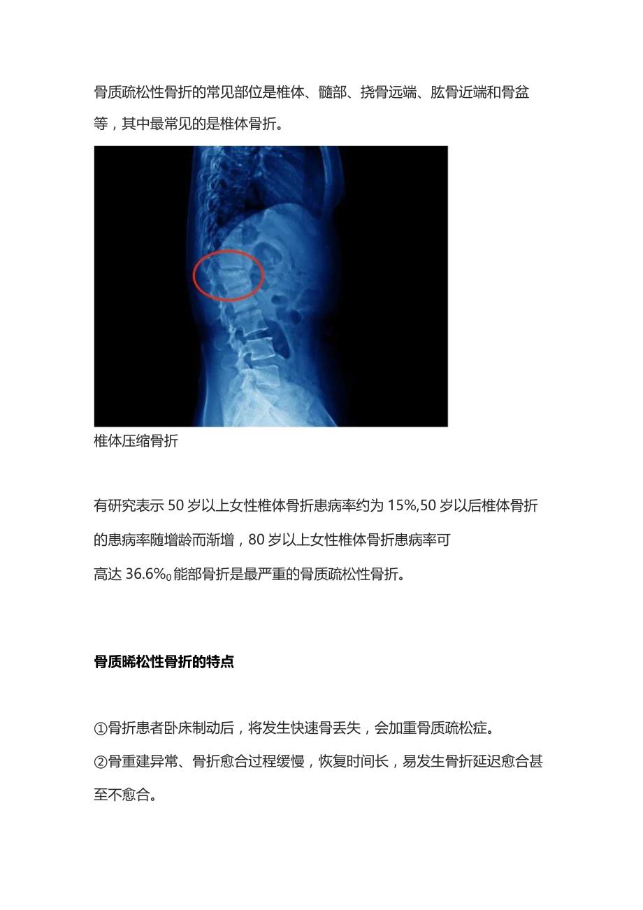 2023骨质疏松性骨折：诊断、治疗和康复.docx_第2页