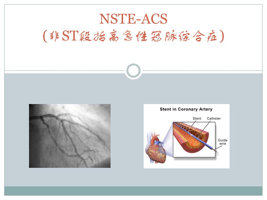 非ST段抬高性急性冠脉综合症.ppt_第1页