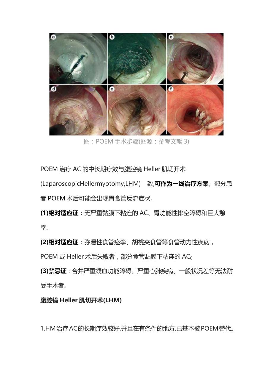 2023贲门失弛缓症的治疗方法.docx_第3页