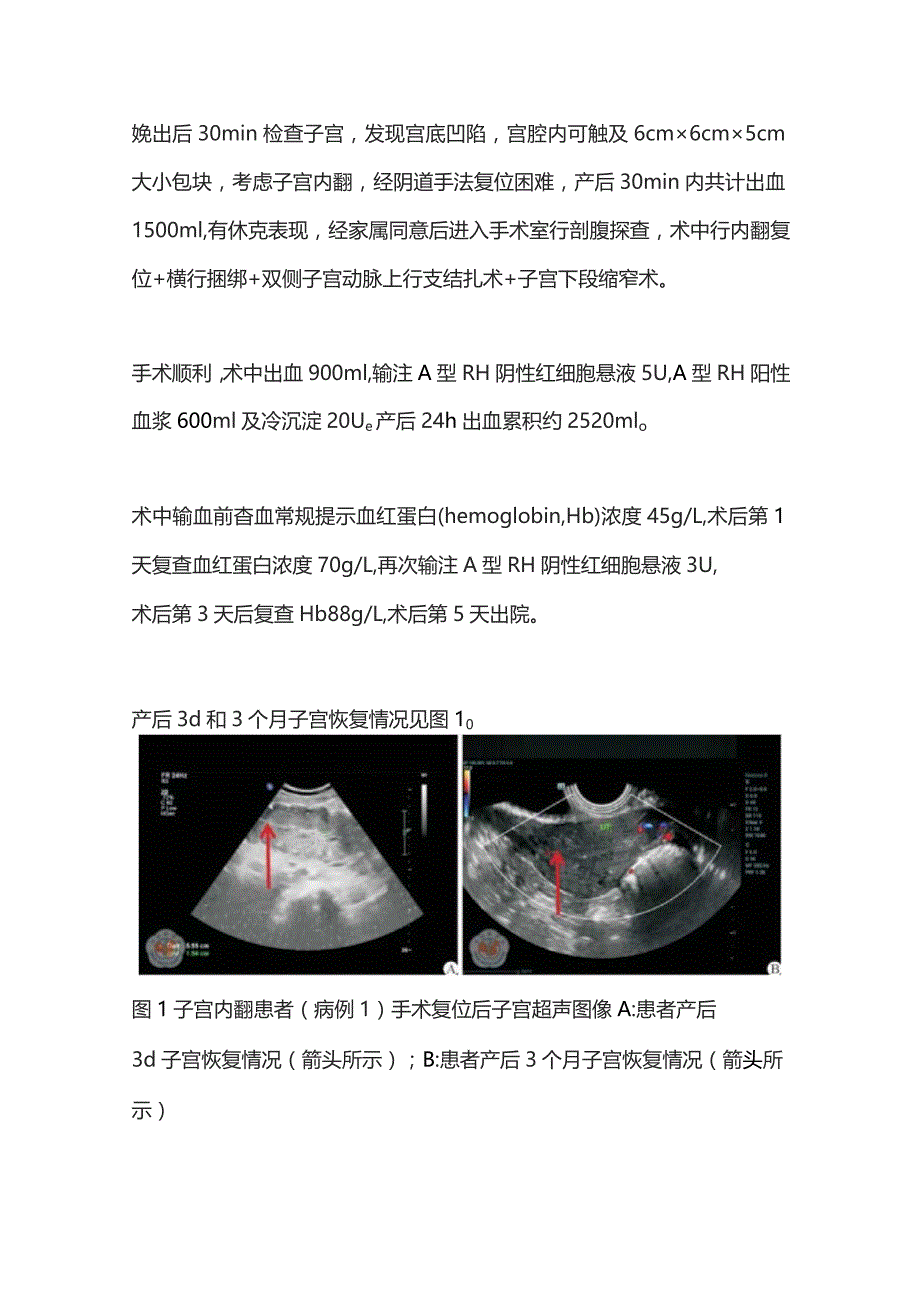 2023产后急性子宫内翻病例临床分析.docx_第3页