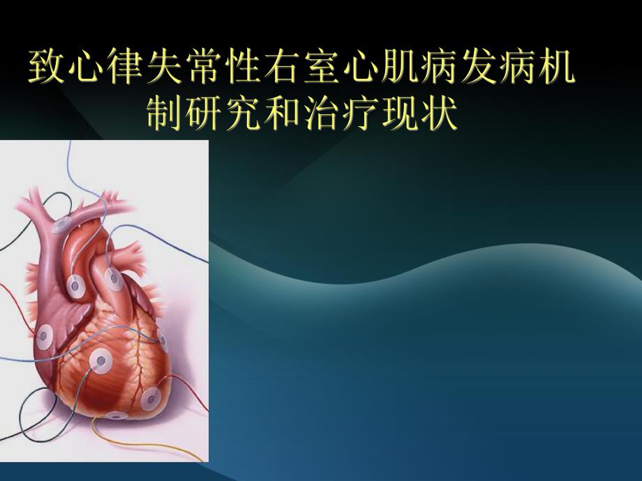 致心律失常性右室心肌病.ppt.ppt_第1页