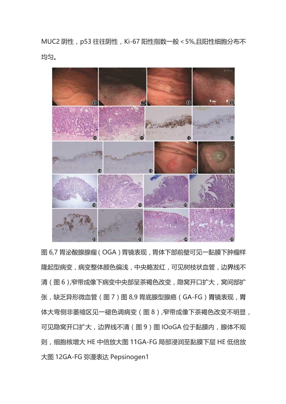 2023胃底腺型肿瘤临床及病理学特点.docx_第3页