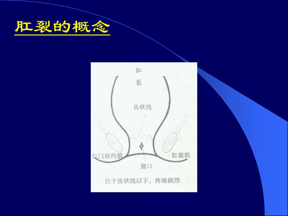 肛裂【PPT精品】 .ppt_第3页