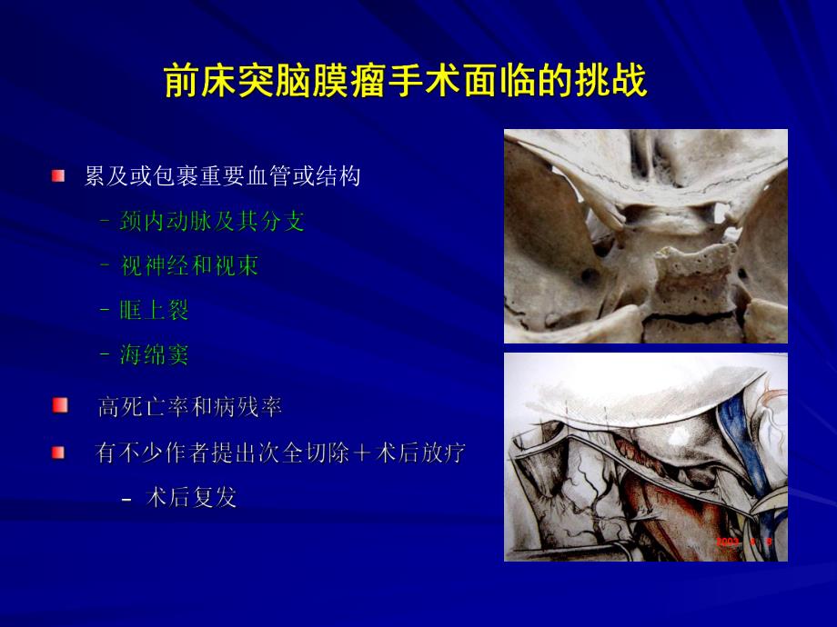 前床突脑膜瘤显微外科手术的几点体会.ppt_第2页