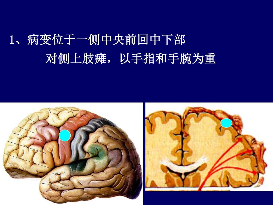 神经内科定位诊断.ppt_第3页