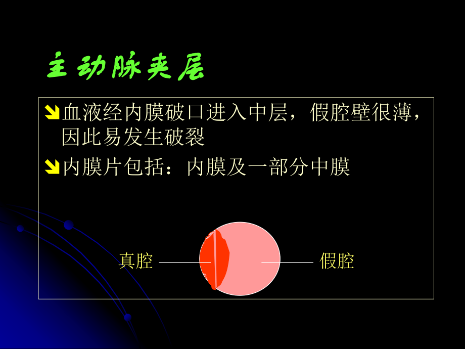 主动脉夹层的影像学表现.ppt_第3页