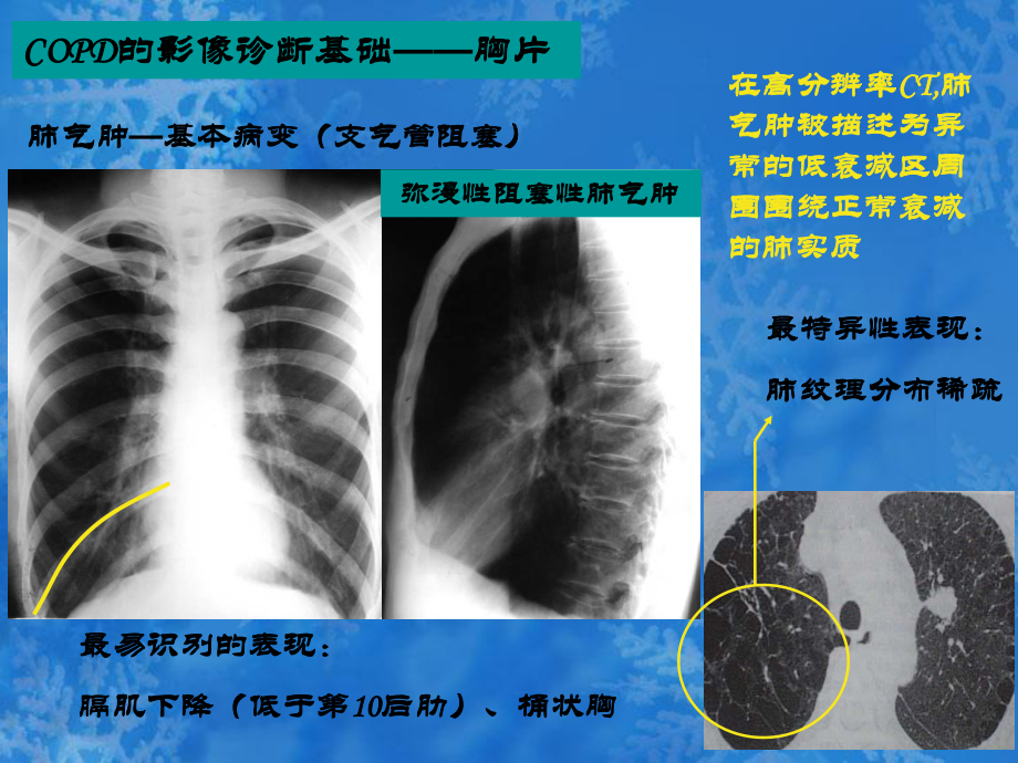 COPD的影像学诊断.ppt_第2页