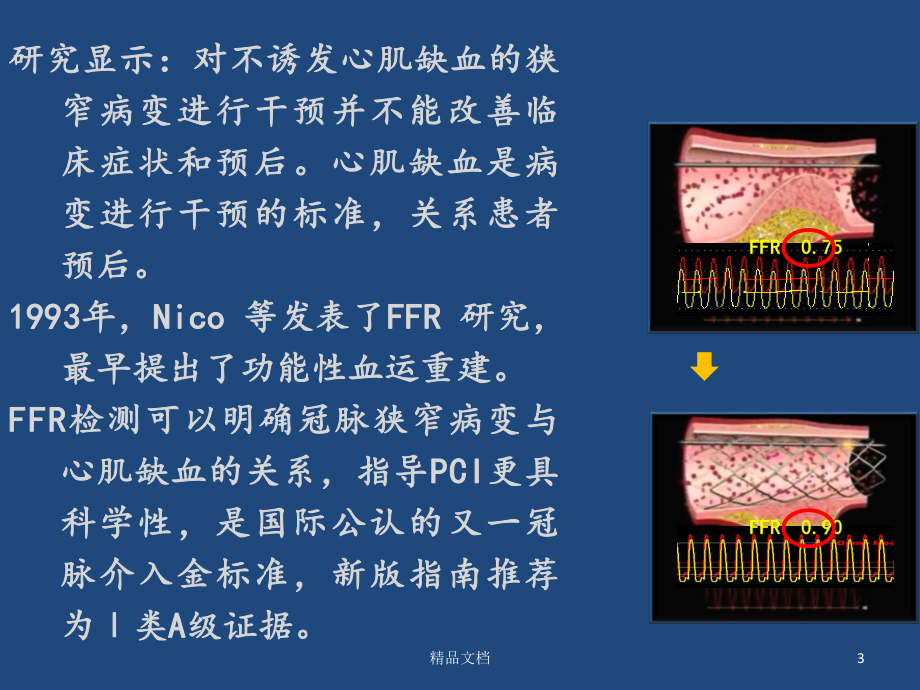 FFR临床应用.ppt_第3页