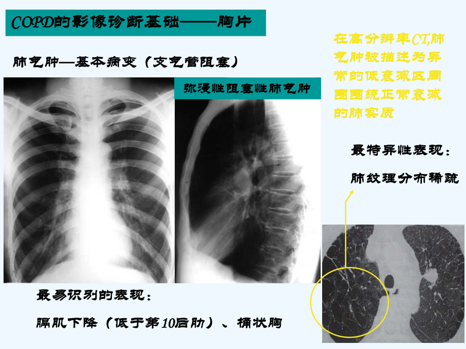 COPD的影像学诊断.ppt_第2页