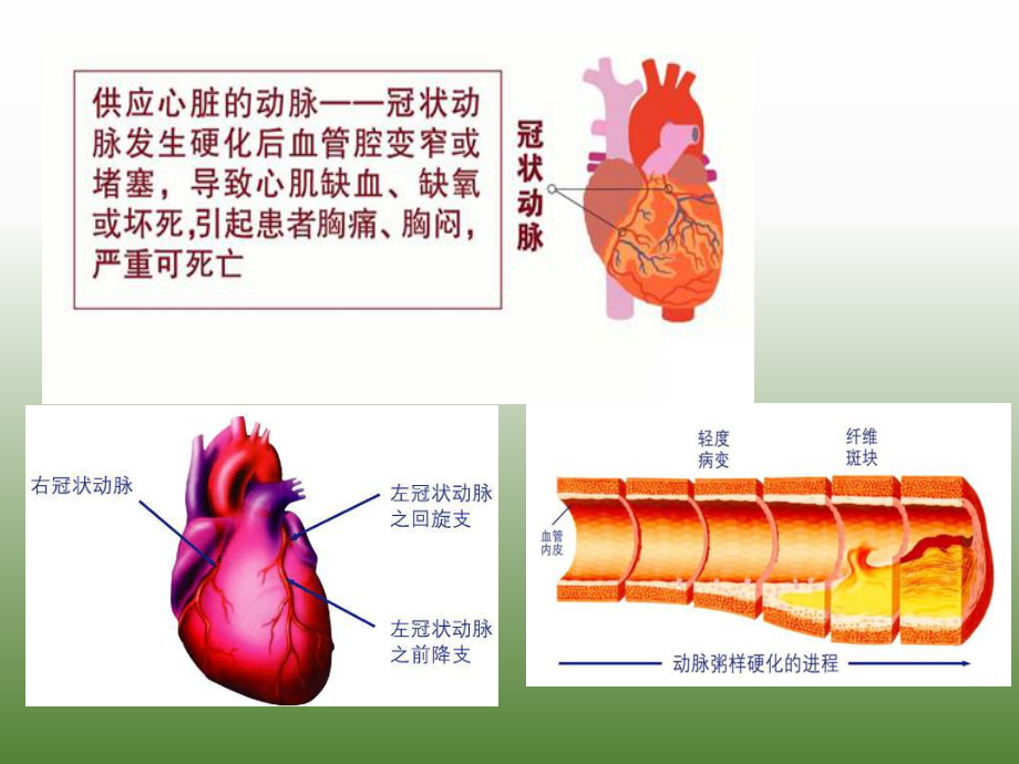 冠心病的诊断与治疗.ppt_第3页