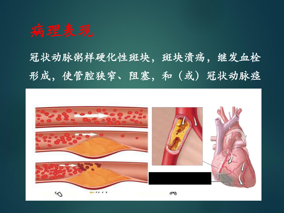 冠心病超声诊断.ppt_第2页