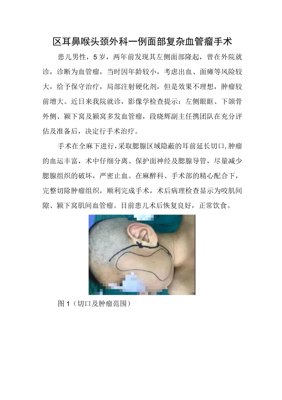 区耳鼻喉头颈外科一例面部复杂血管瘤手术.docx_第1页