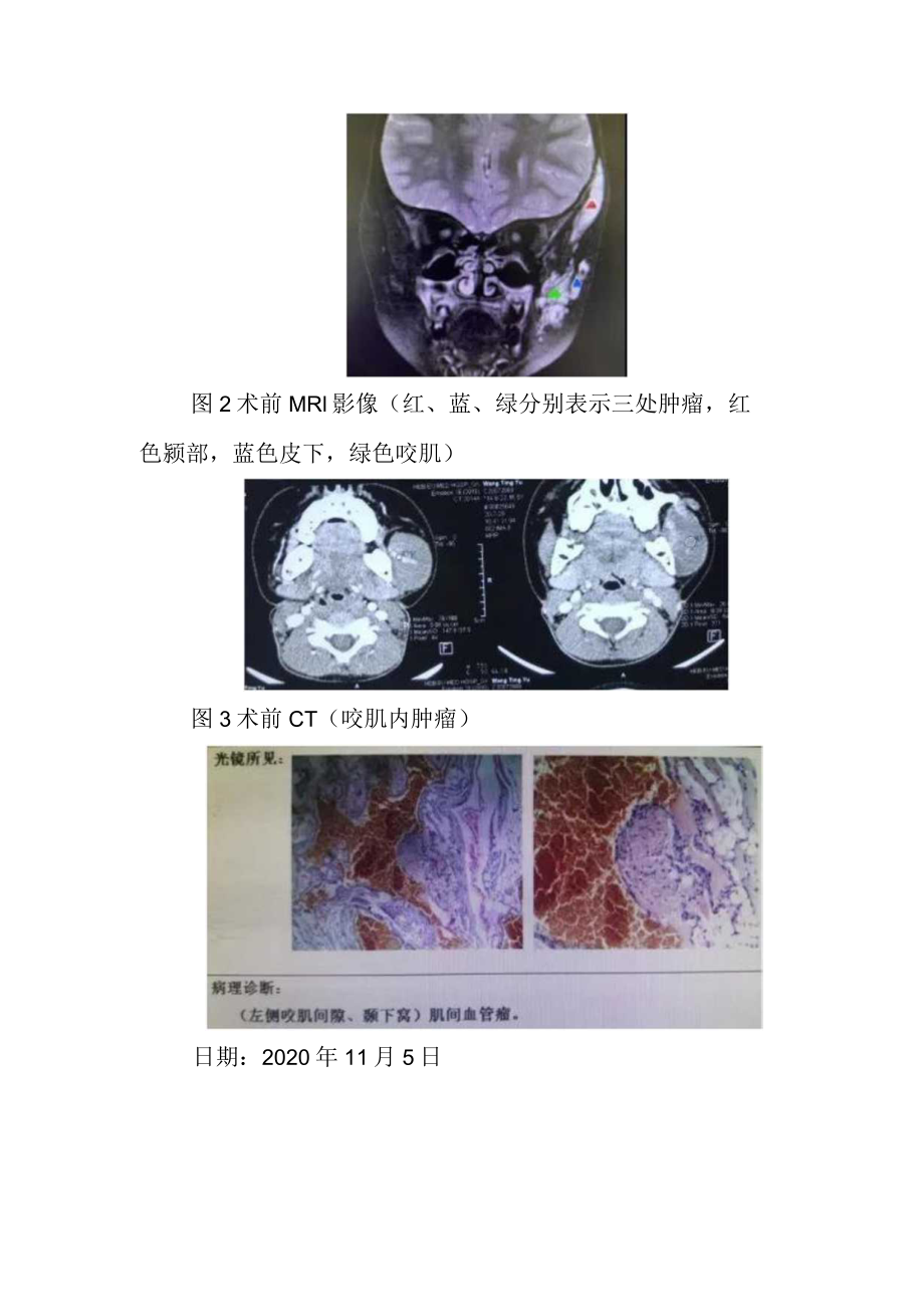 区耳鼻喉头颈外科一例面部复杂血管瘤手术.docx_第2页