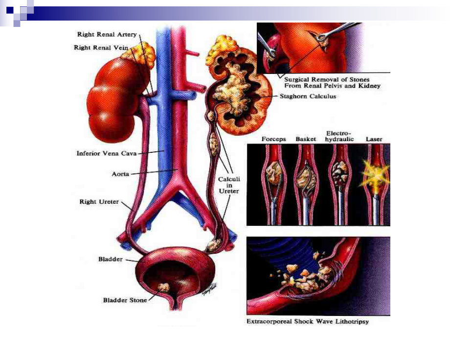 泌尿结石的健康教育1.ppt_第2页