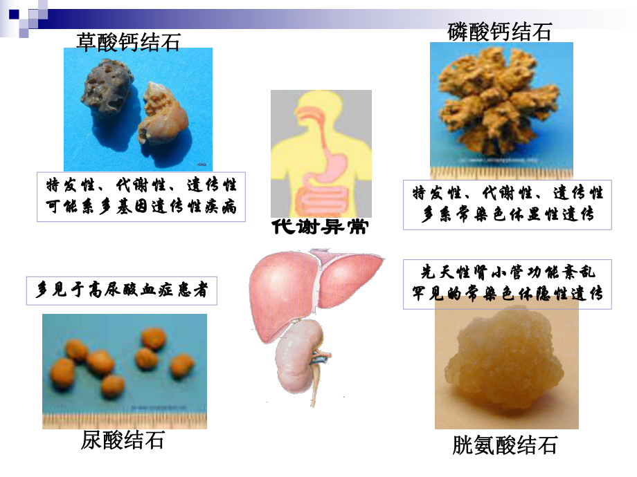 泌尿结石的健康教育1.ppt_第3页