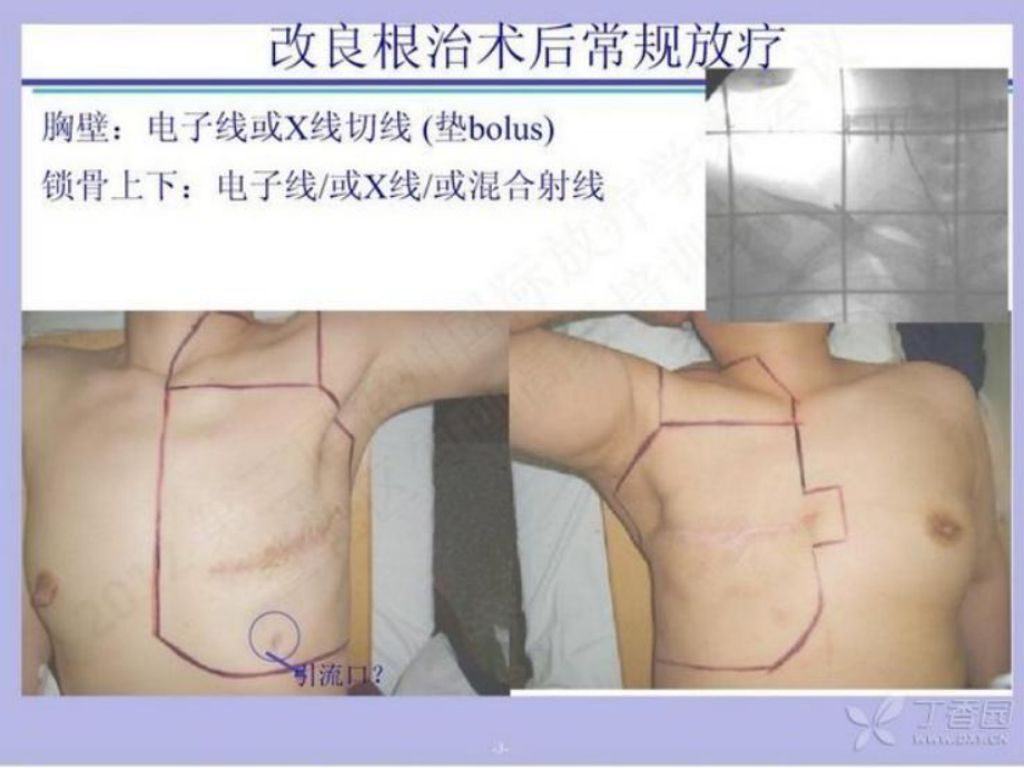 乳腺癌靶区勾画.ppt_第3页