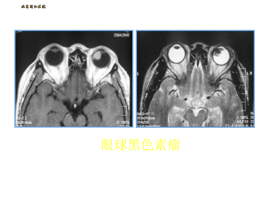 眼球肿瘤的影像学诊断.ppt_第3页