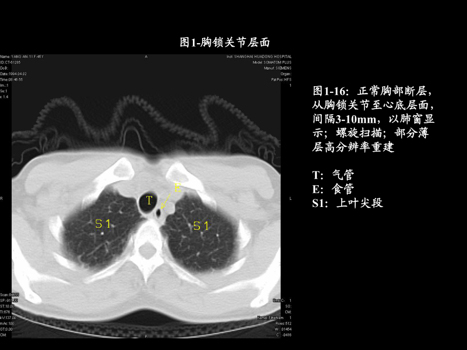 胸部CT的影像学表现.ppt_第1页