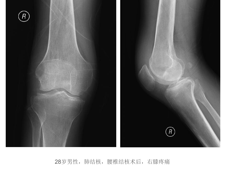 膝关节结核的影像学诊断.ppt_第2页