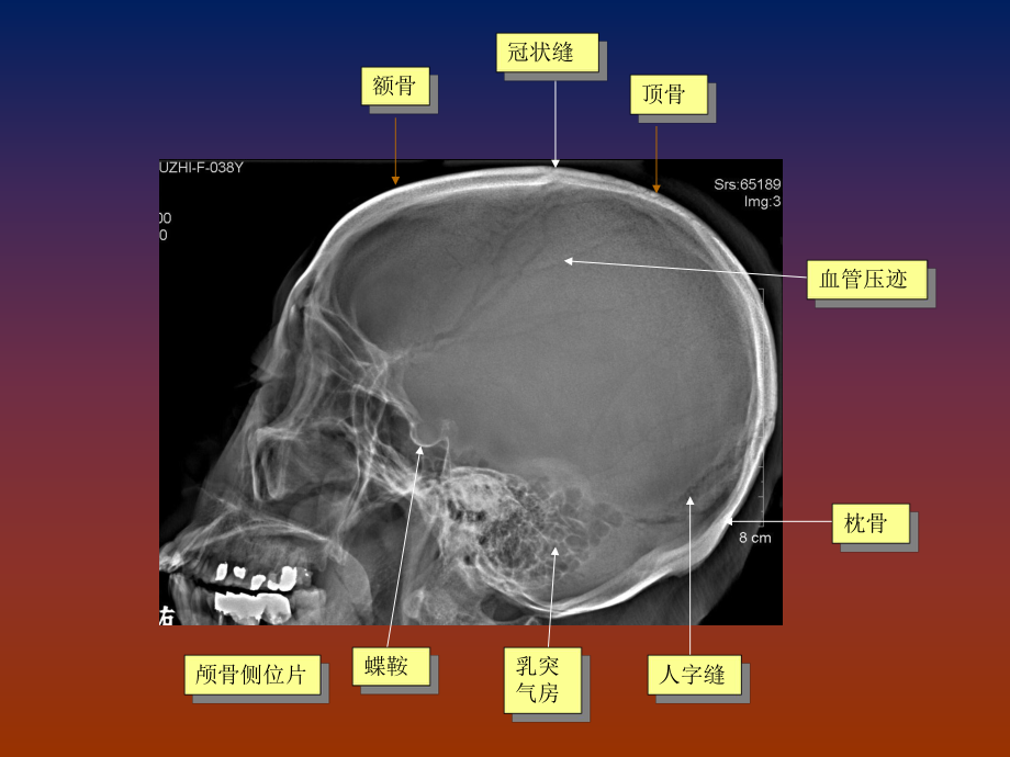 脑血管畸形影像学诊断.ppt_第3页