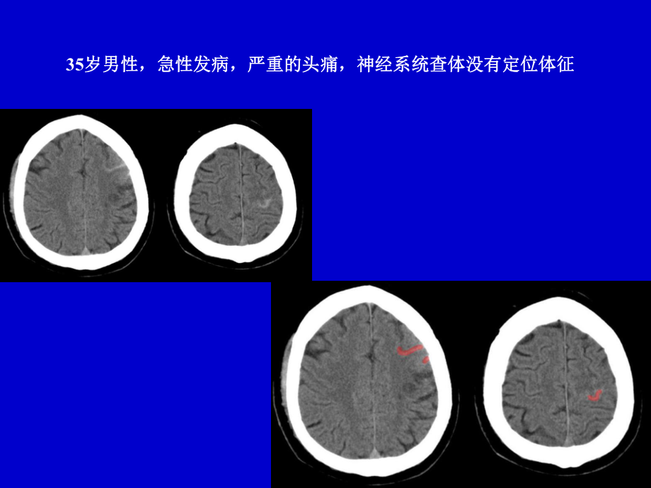 脑动脉瘤的影像学—高旭光.ppt_第2页