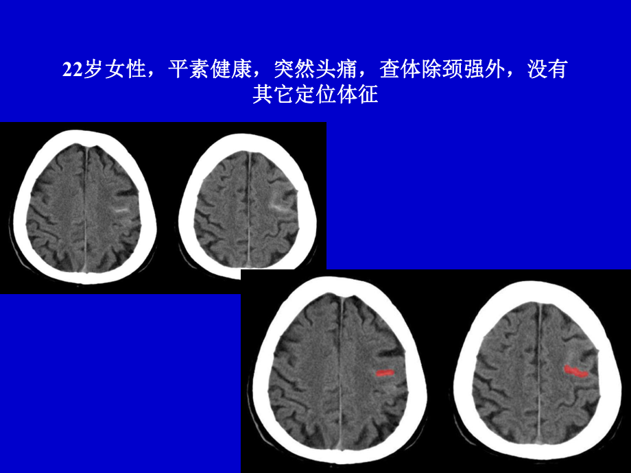 脑动脉瘤的影像学—高旭光.ppt_第3页