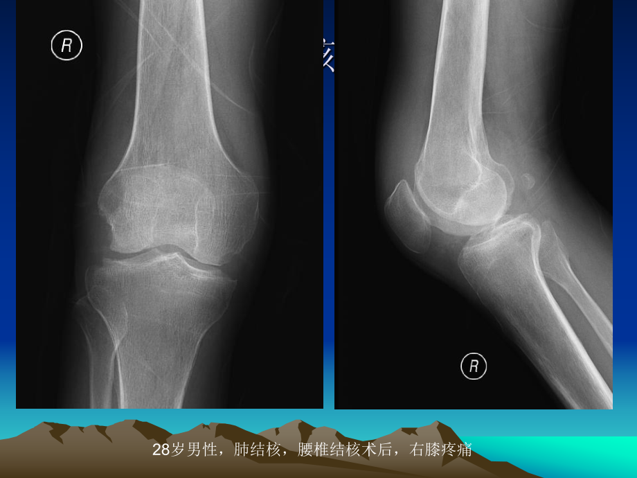 膝关节结核的影像学诊断.ppt_第2页