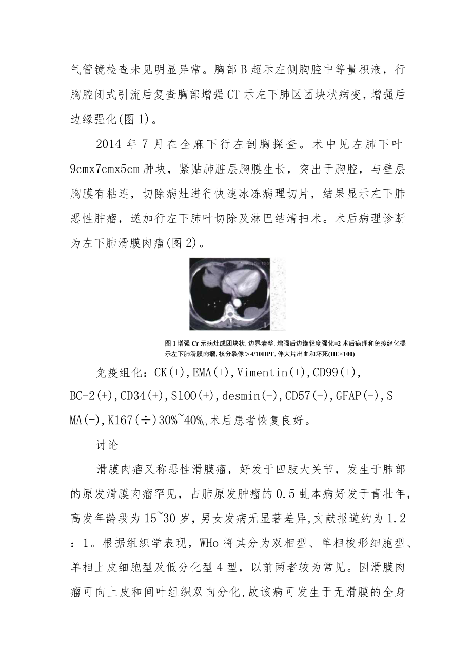 呼吸内科晋升副主任医师专题报告(肺滑膜肉瘤病例分析).docx_第2页