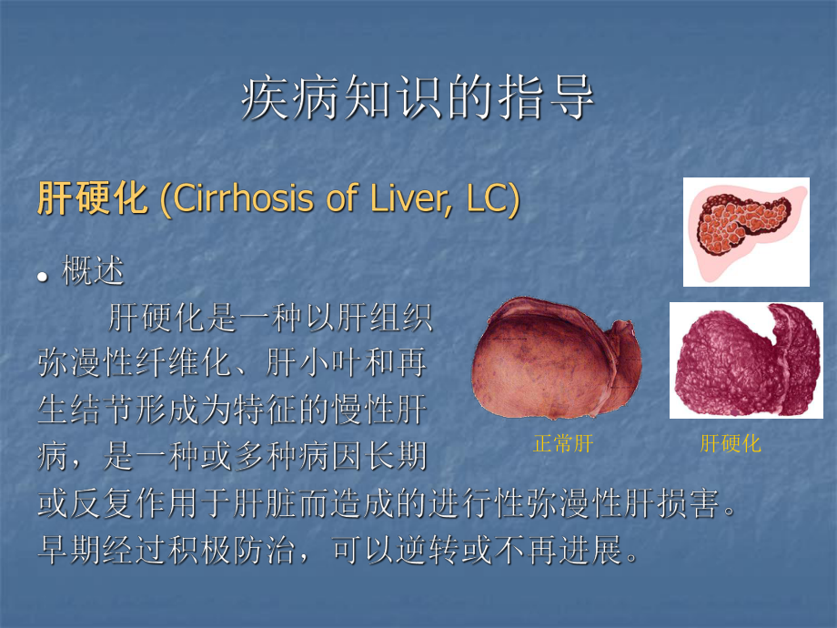 肝硬化的健康教育.ppt_第2页