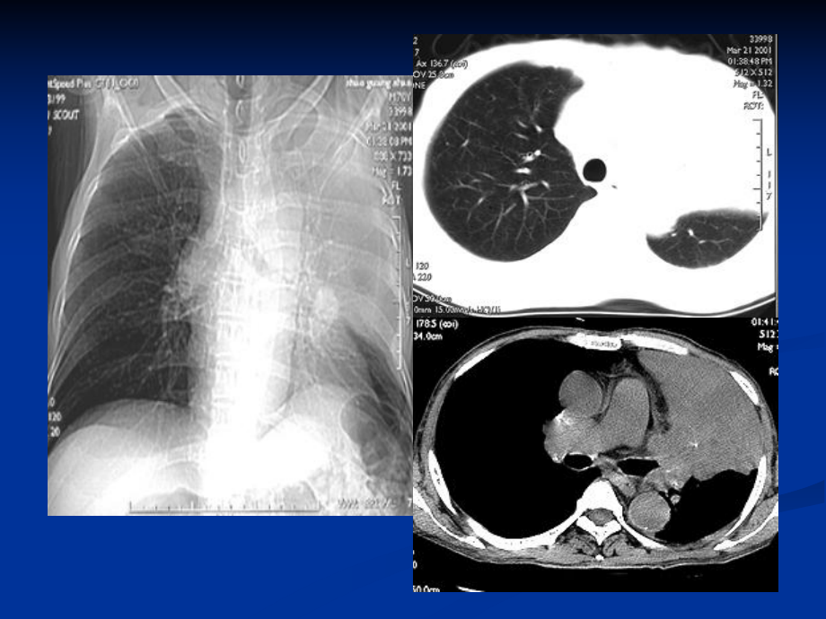 肺部病变的影像学诊断.ppt_第2页