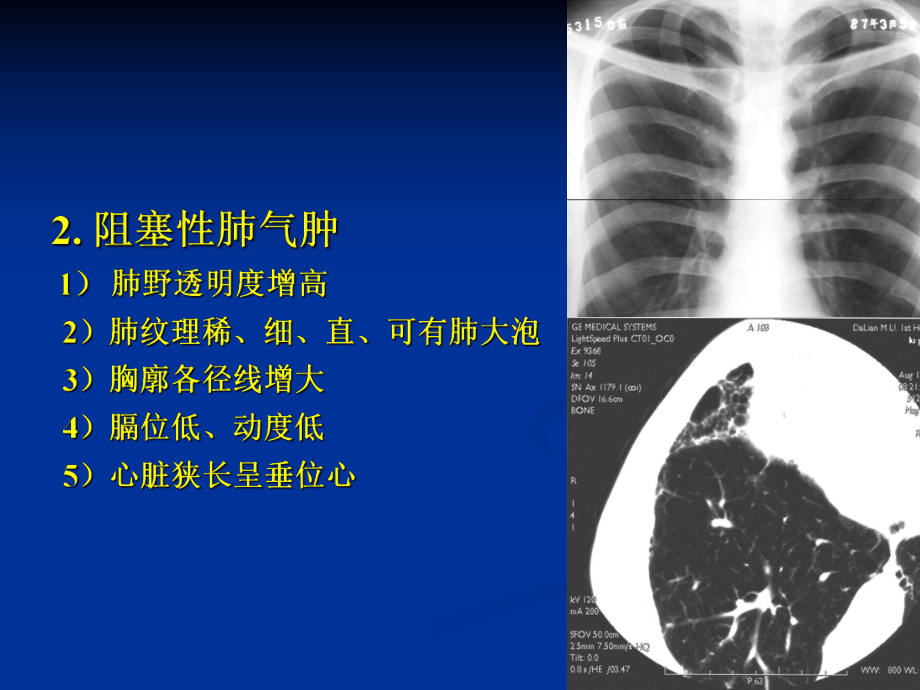 肺部病变的影像学诊断.ppt_第3页