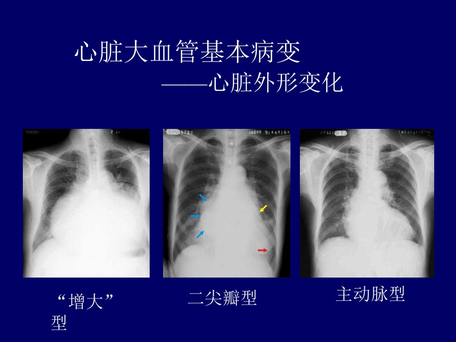 心血管疾病影像学诊断.ppt_第3页