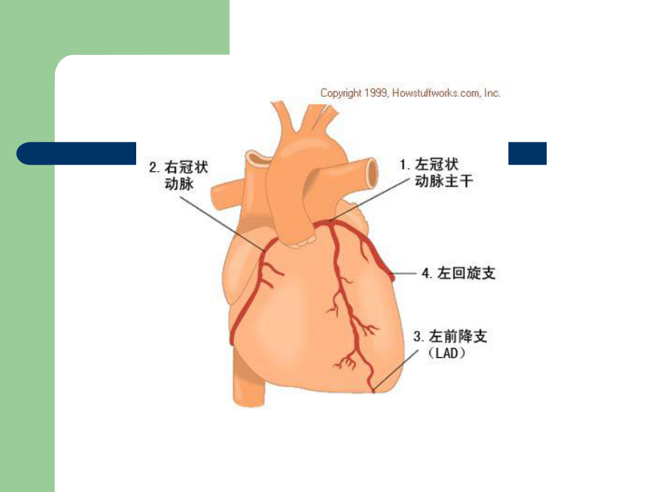 冠心病的典型心电图表现.ppt_第3页