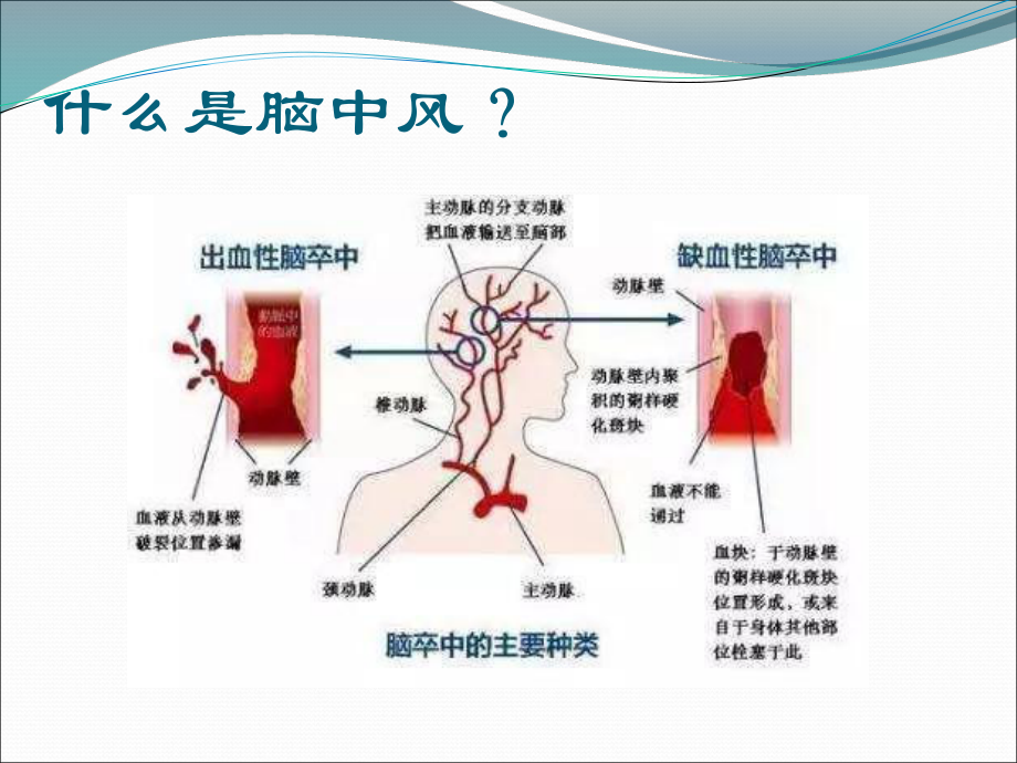 “脑中风”的预防健康教育.ppt_第2页