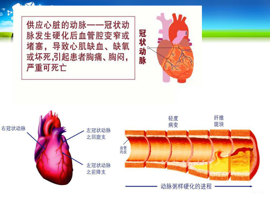 冠心病的康复.ppt_第3页