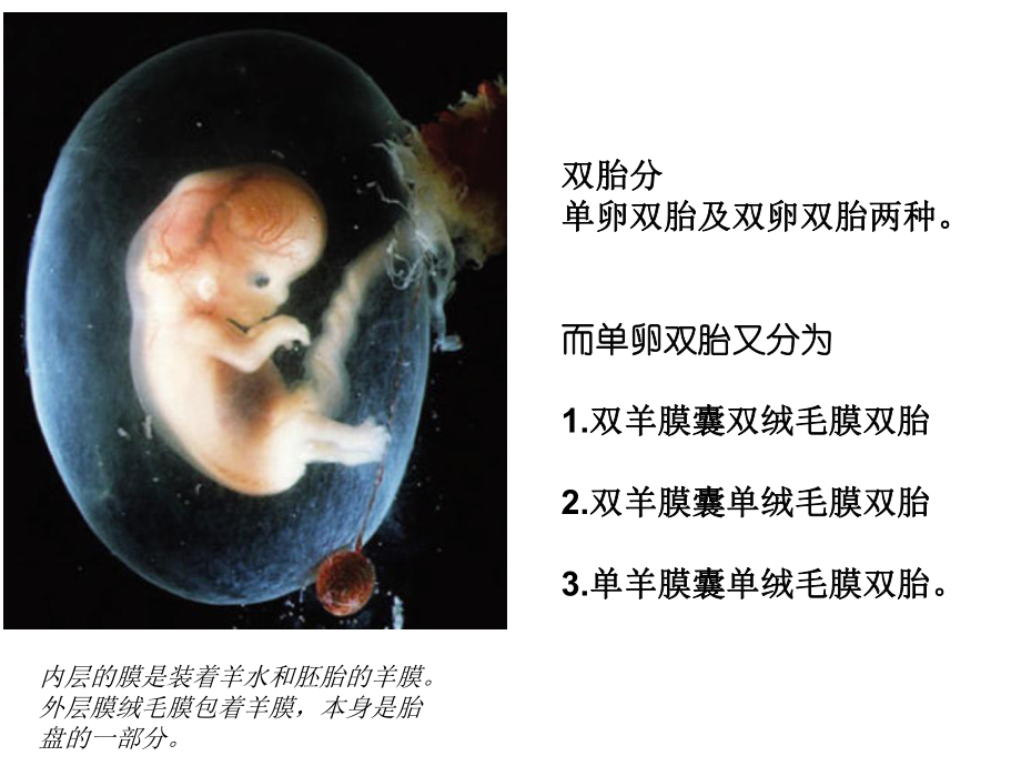 【医学PPT课件】双胎输血综合征.ppt_第3页