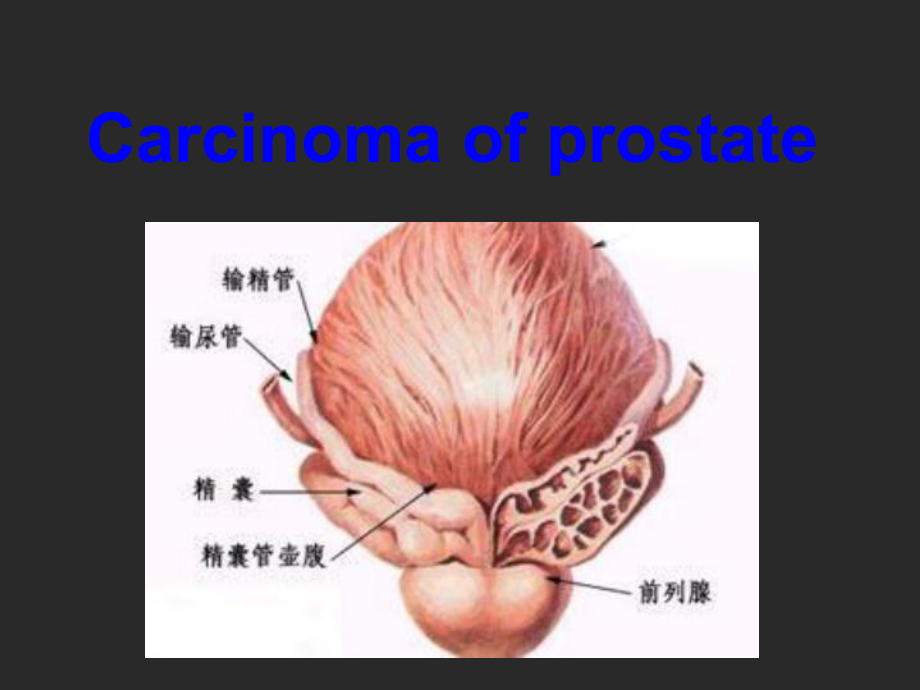 前列腺癌英文版精品医学课件.ppt_第1页