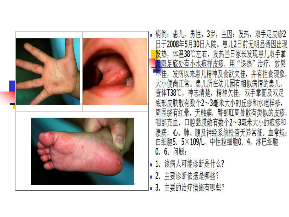 手足口病医学课件.ppt_第2页