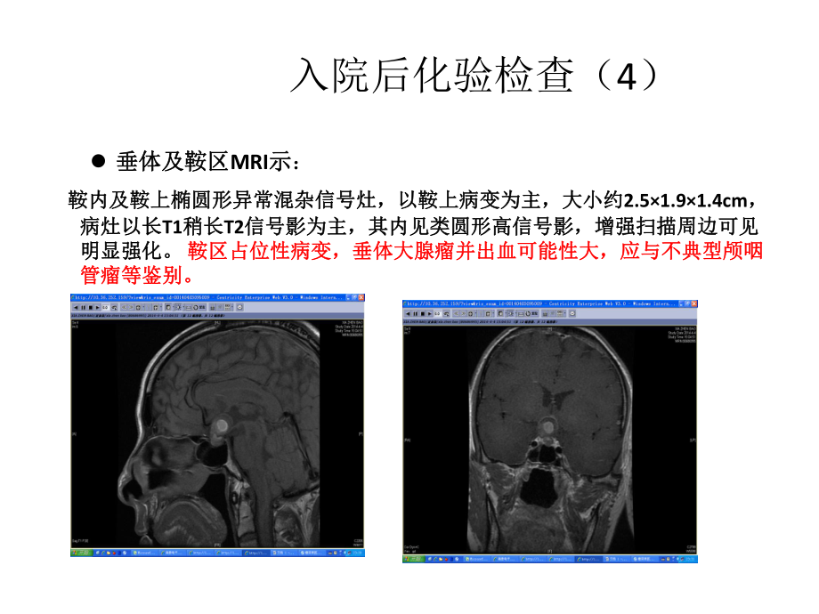 【医学课件】垂体占位PPT.pptx_第1页