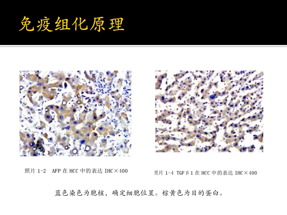 乳腺癌的免疫标志物.pptx_第3页