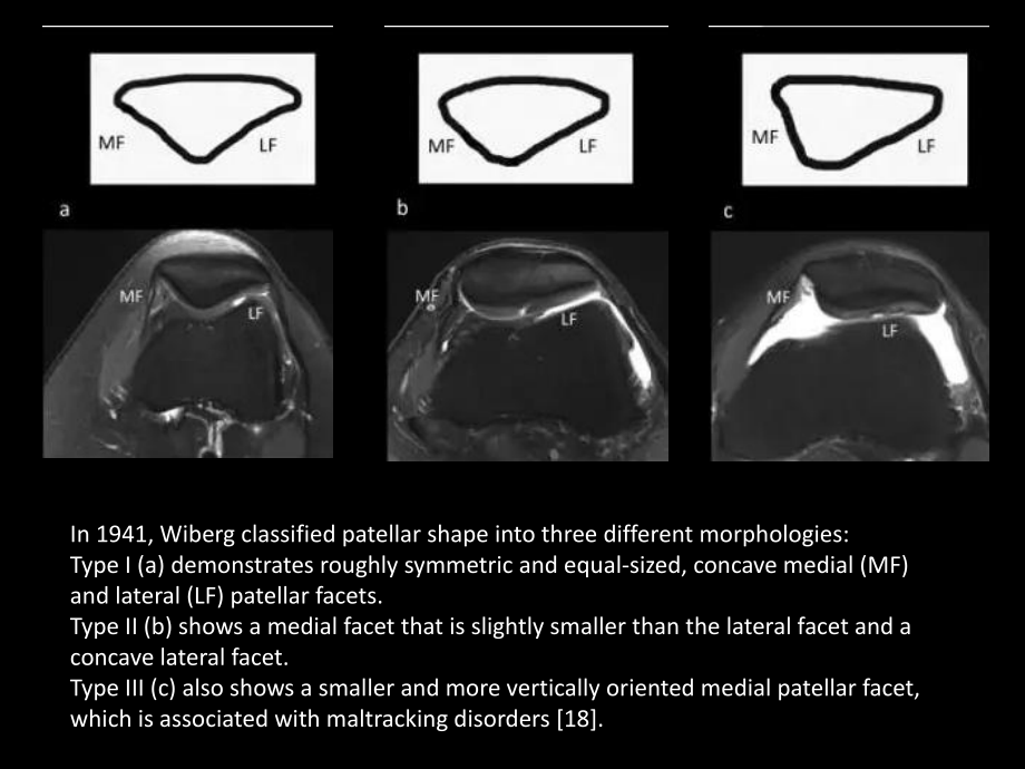 髌骨病变的影像学表现.pptx_第3页