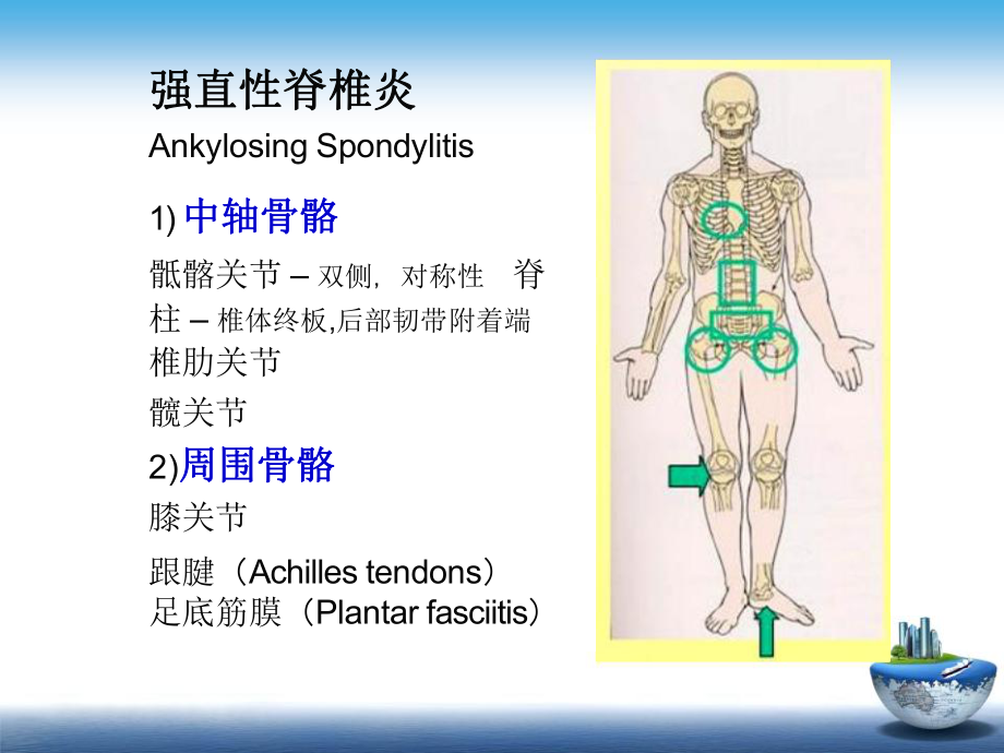 强直性脊柱炎的影像学诊断PPT.pptx_第3页