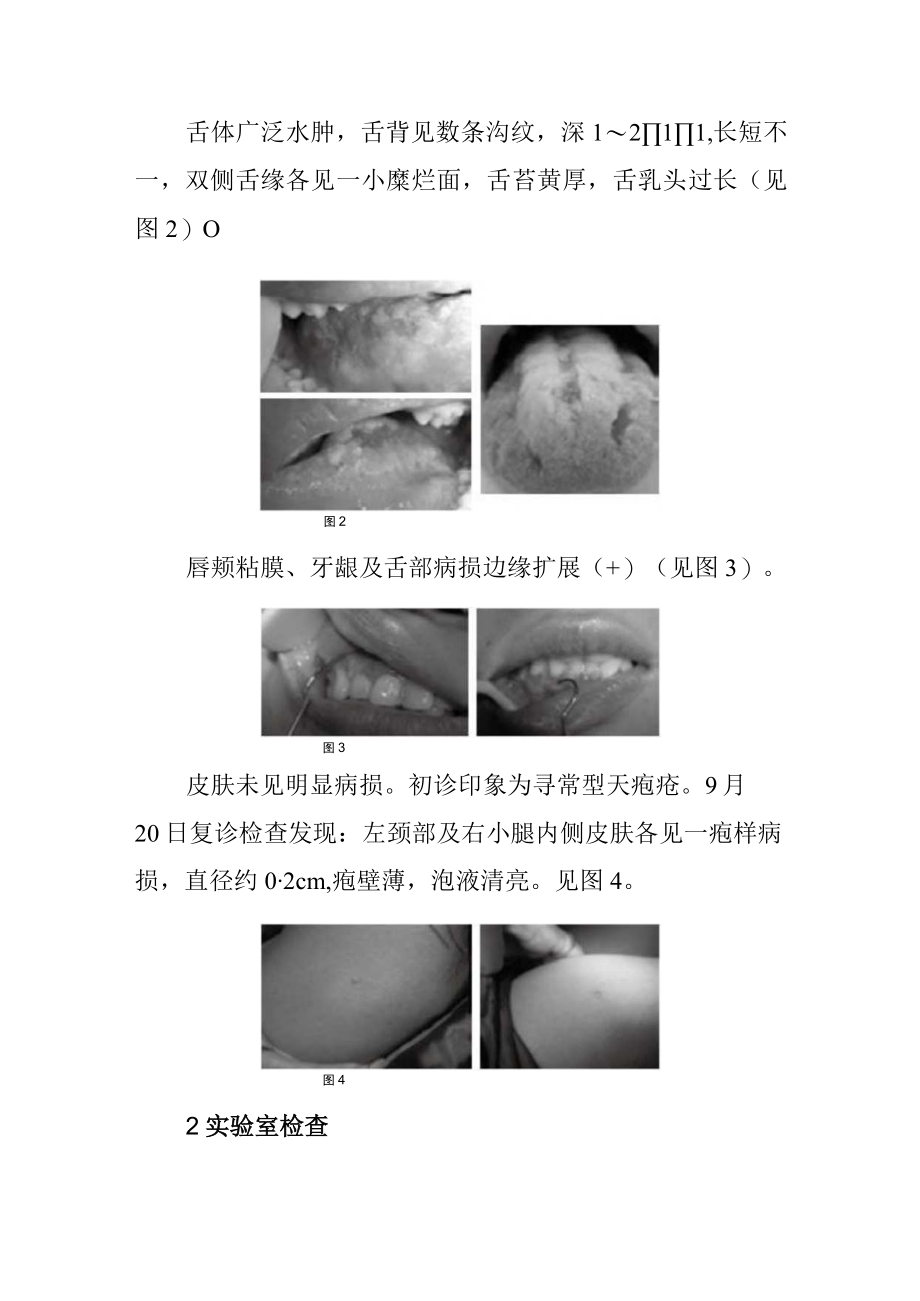 中医黏膜科寻常型天疱疮病例分析专题报告.docx_第2页