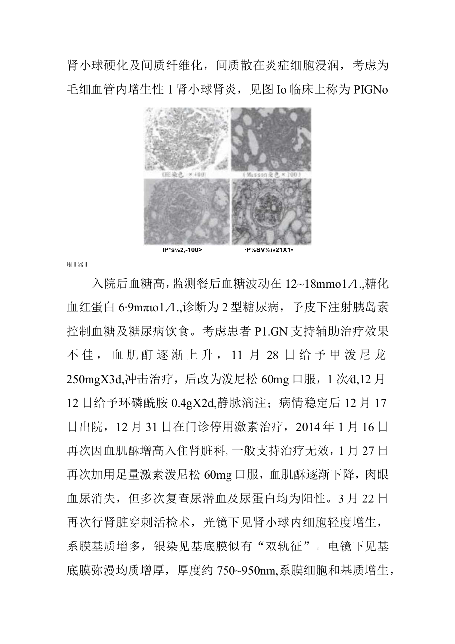 烧伤科特重度烧伤致感染后肾小球肾炎病例分析专题报告.docx_第2页