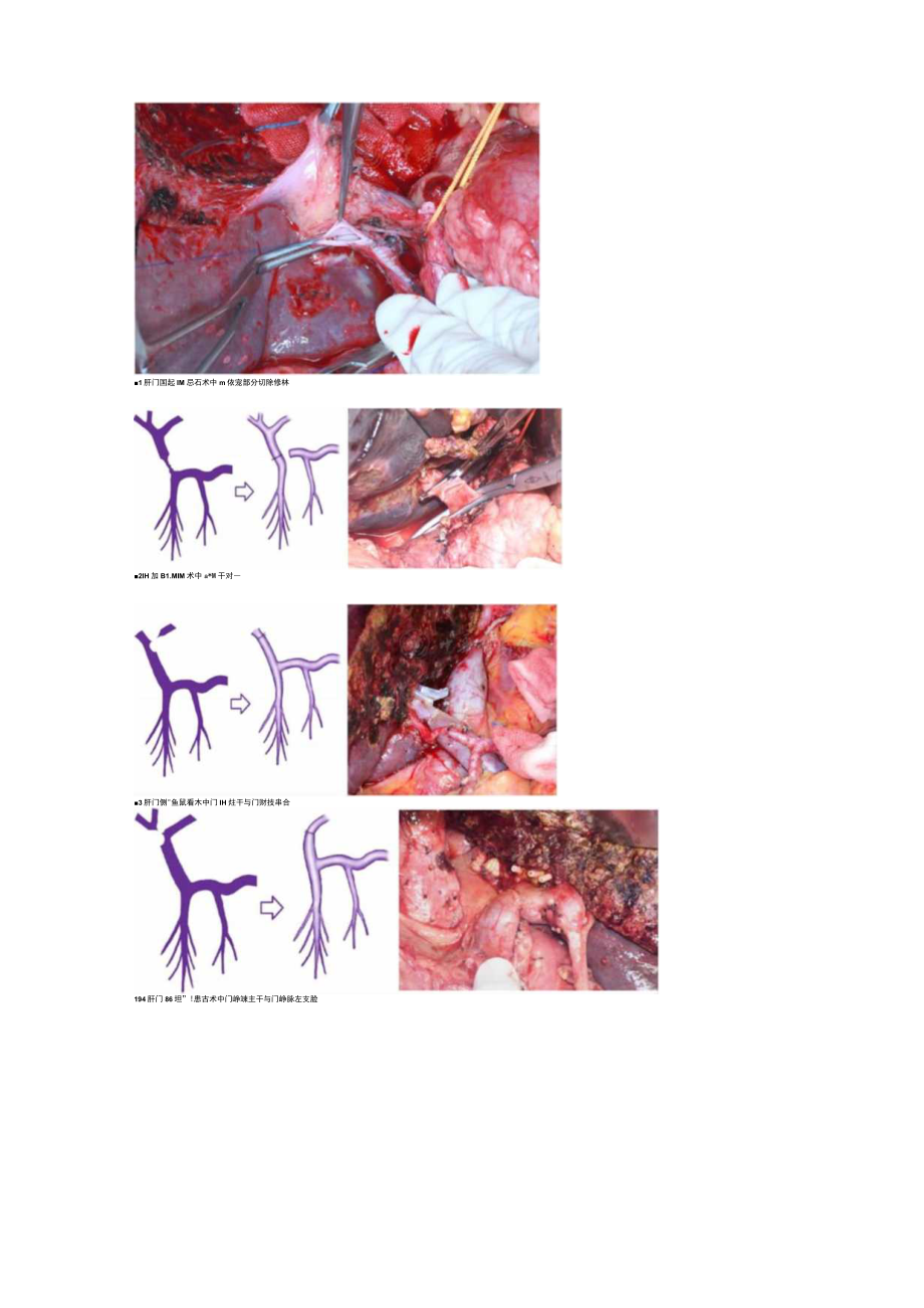 2022肝门部胆管癌根治术中联合血管切除重建的技术要点（全文）.docx_第3页