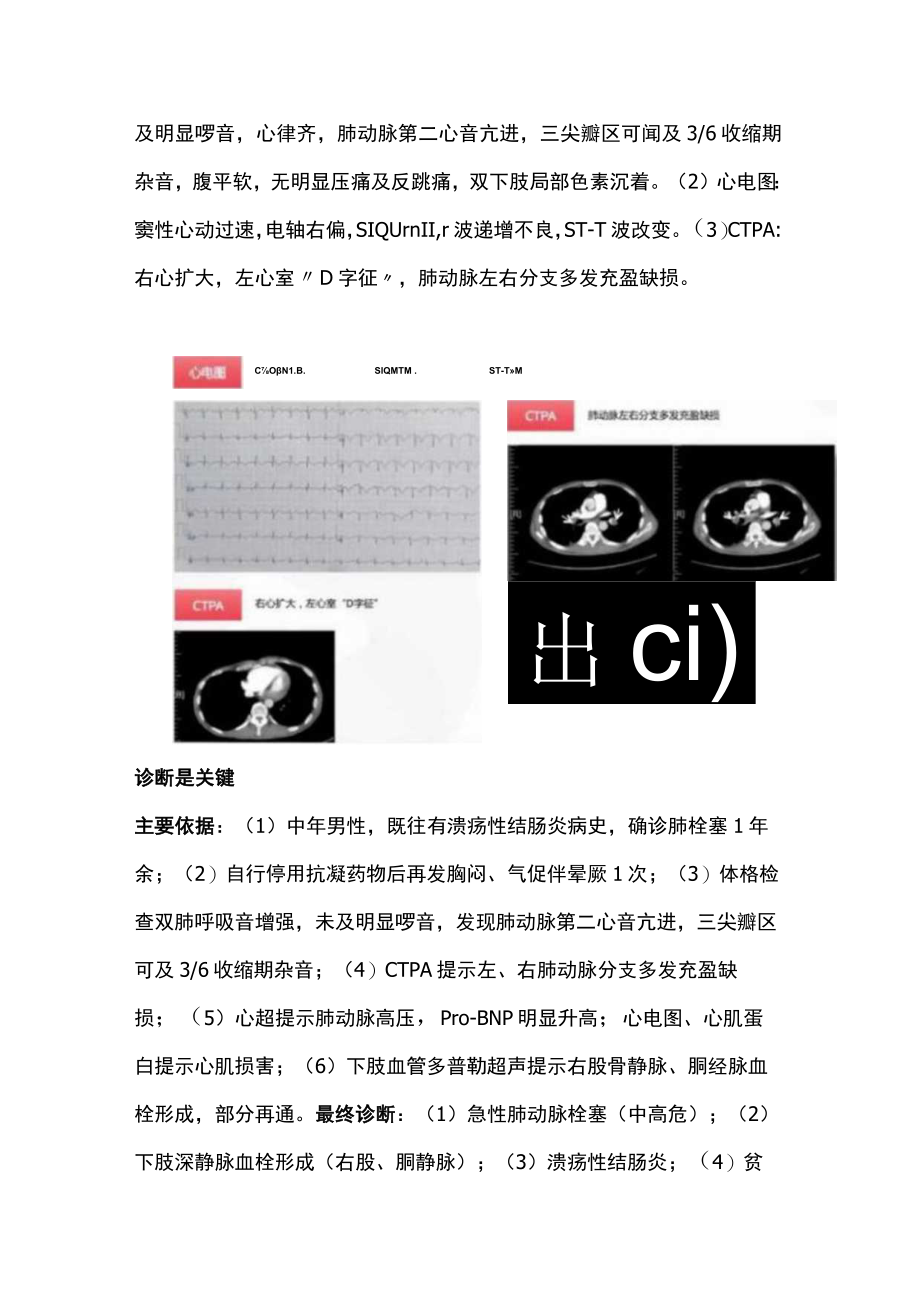 2022急性肺栓塞的快速诊断（全文）.docx_第2页