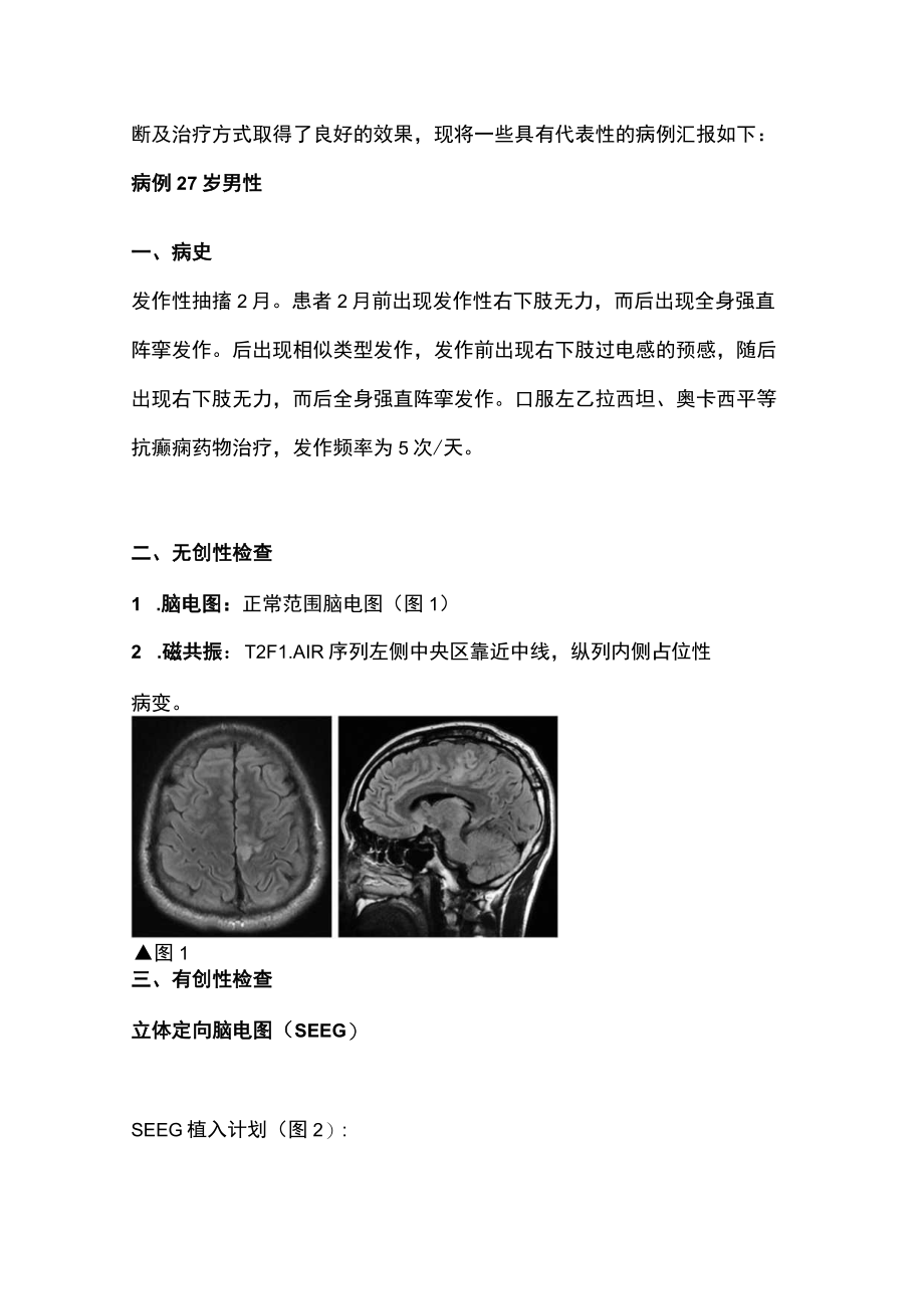 2022运动功能区肿瘤伴癫痫的手术治疗（全文）.docx_第2页