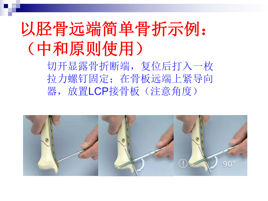 LCP操作指南(中和和桥接原则的使用).ppt_第2页