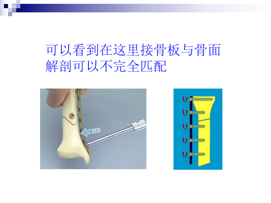 LCP操作指南(中和和桥接原则的使用).ppt_第3页